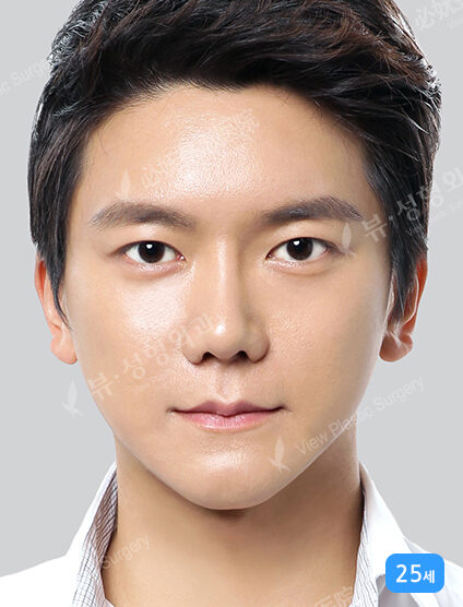 Acculifting+Nano Two Jaw+Natural Vline+Anterior Cheekbones Implant +T.O.P Surgery+Ptosis+Forehead Implant (1 Year 3 Months) — After