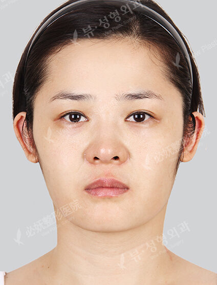 Omega Lifting+Mint Lifting+Fat Graft(1 Months) — Before
