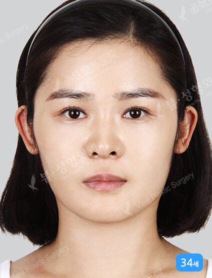 Omega Lifting+Mint Lifting+Fat Graft(1 Months) — After