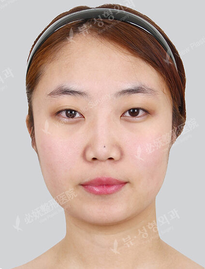 Forehead Frontal Cheeks Fat Graft — Before