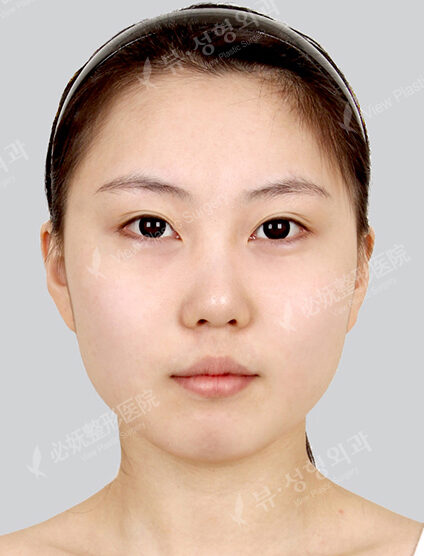 Forehead , Cheeks , Nasolabial Fat Graft — Before