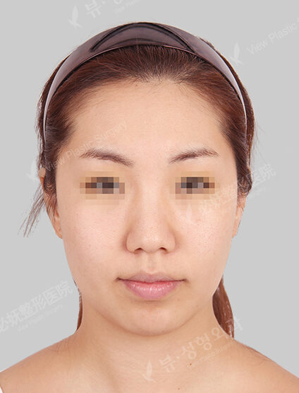 Hump Nose +Bulbous Nose+Fat Graft (Forehead Frontal Cheeks Nasolabial Front Chin)(3 Months) — Before