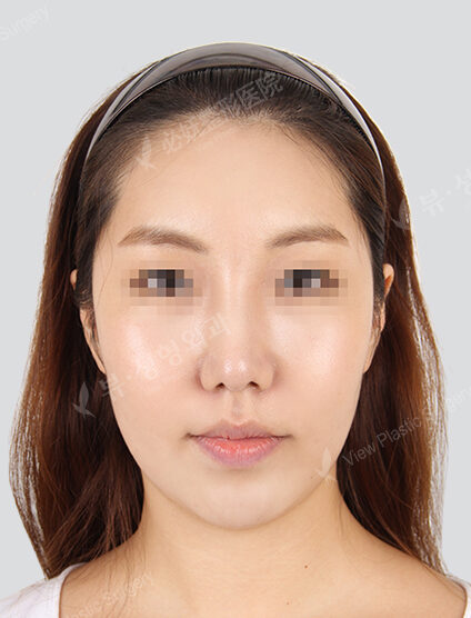 Hump Nose +Bulbous Nose+Fat Graft (Forehead Frontal Cheeks Nasolabial Front Chin)(3 Months) — After