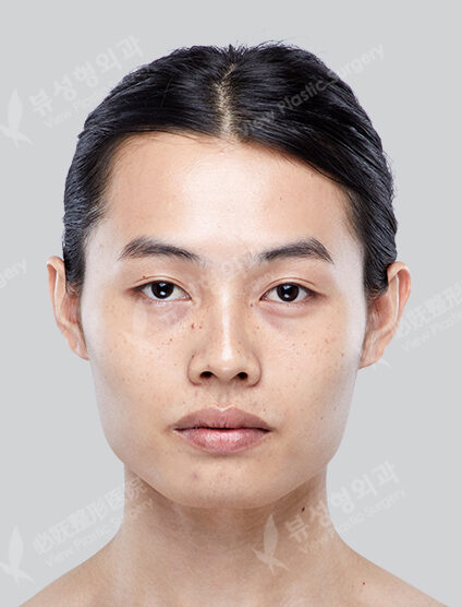 Face Fat Graft+Ptosis+Rhinoplasty+Zygoma Reduction+Angular Jaw+Front Chin+PA (6 Months) — Before