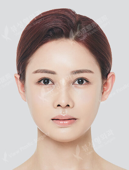 Face Fat Graft+Ptosis+Rhinoplasty+Zygoma Reduction+Angular Jaw+Front Chin+PA (6 Months) — After
