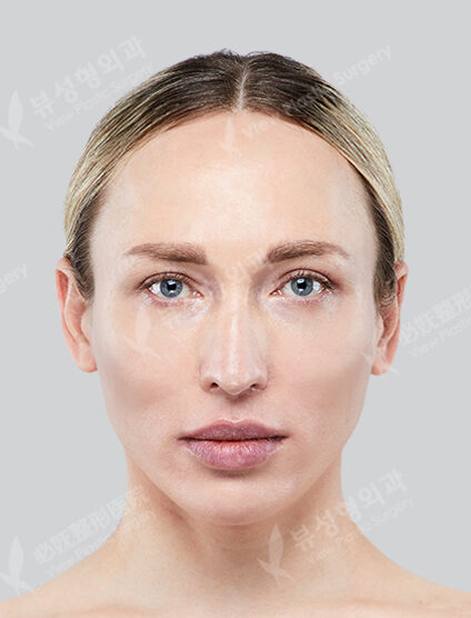 Fat Graft (6 Months) — Before