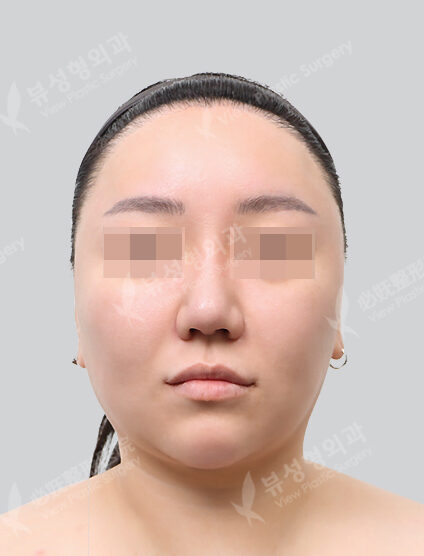 Lifting (Face ,Neck)+ Liposuction (Cheeks ,ChinLine)(3 Months) — Before