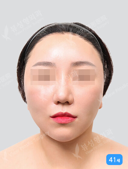 Lifting (Face ,Neck)+ Liposuction (Cheeks ,ChinLine)(3 Months) — After