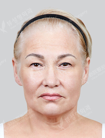Endotine+Face Lift+Neck Lifting (3 Months) — Before