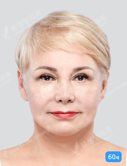 Endotine+Face Lift+Neck Lifting (3 Months) — After