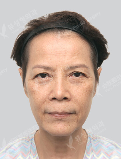 Face Lift+Neck Lifting (3 Months) — Before