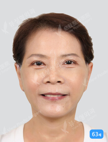Face Lift+Neck Lifting (3 Months) — After