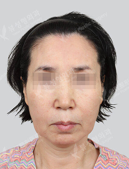 + Double Chin+Upper Blepharoplasty (Revisional Surgery) Ptosis+ForeheadLifting (3 Months) — Before