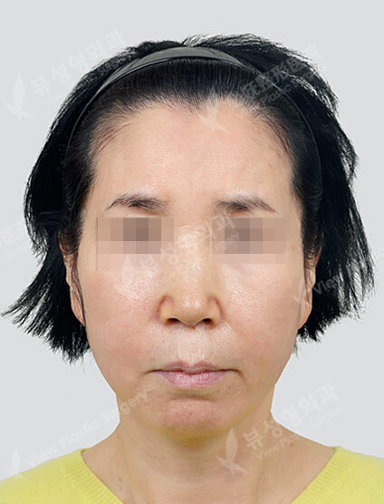 + Double Chin+Upper Blepharoplasty (Revisional Surgery) Ptosis+ForeheadLifting (3 Months) — After