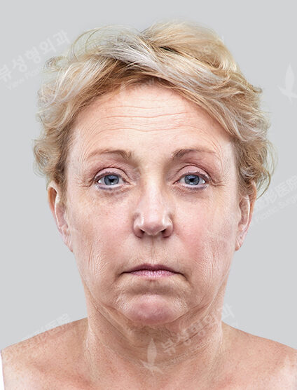 (Neck )+ Filler + Forehead Botox (3 Months) — Before