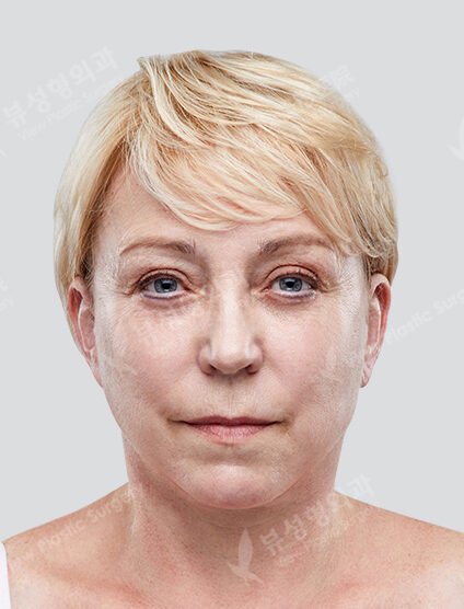 (Neck )+ Filler + Forehead Botox (3 Months) — After