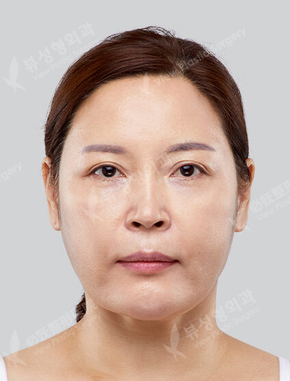 Upper Blepharoplasty, Mint Lifting ,Filler — Before