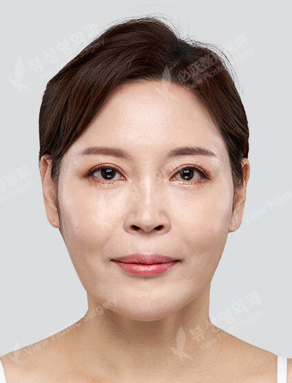 Upper Blepharoplasty, Mint Lifting ,Filler — After