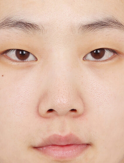Hump Nose(4 Months ) — Before