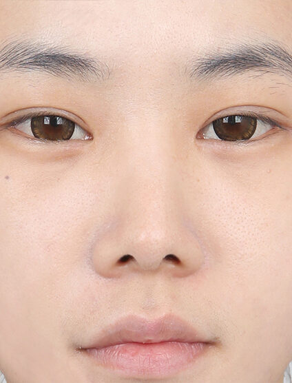 Hump Nose(4 Months ) — After