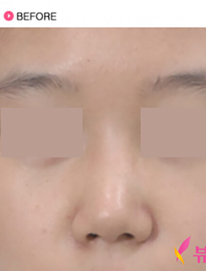 Rhinoplasty(3 Months) — Before