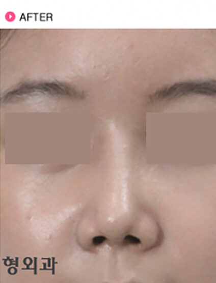 Rhinoplasty(3 Months) — After