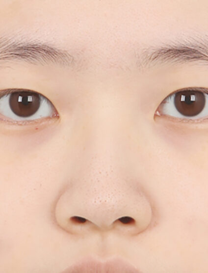 Rhinoplasty(3 Months) — Before