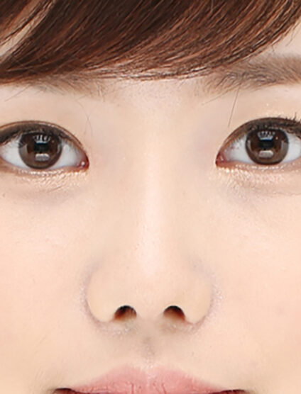 Rhinoplasty(3 Months) — After