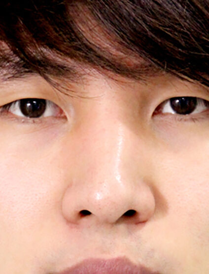 T.O.PRhinoplasty(3 Months) — Before