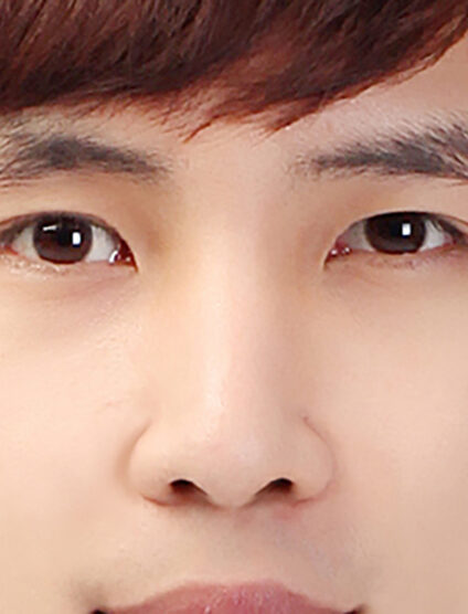 T.O.PRhinoplasty(3 Months) — After
