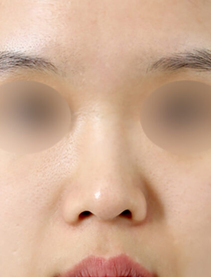 Rhinoplasty(3 Months) — Before