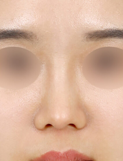 Rhinoplasty(3 Months) — After