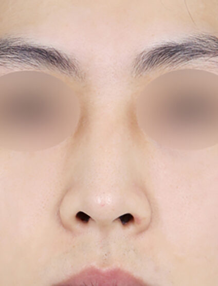 Rhinoplasty(3 Months) — Before