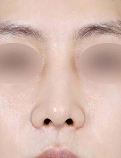Rhinoplasty(3 Months) — After