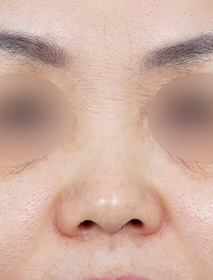 Rhinoplasty (2 Months ) — Before