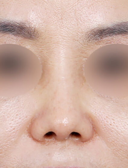 Rhinoplasty (2 Months ) — After