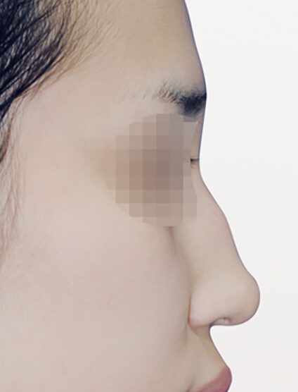 Hump Nose (3 Months) — Before