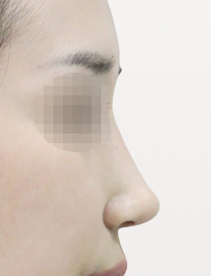 Hump Nose (3 Months) — After