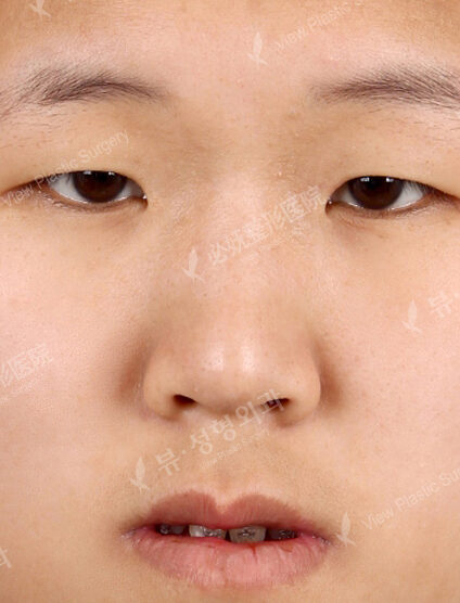 Low Nose (2 Months ) — Before