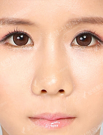 Low Nose (2 Months ) — After