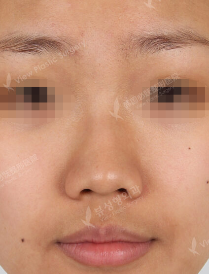 Hump Nose +Weir Reduction+Fat Graft (Face)(3 Months) — Before