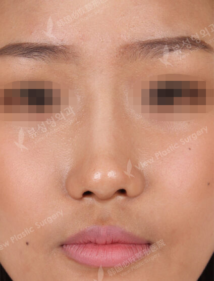 Hump Nose +Weir Reduction+Fat Graft (Face)(3 Months) — After