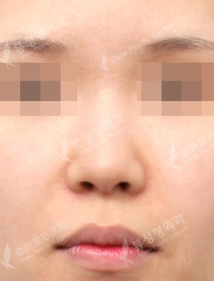 Rhinoplasty (4 Months) — Before