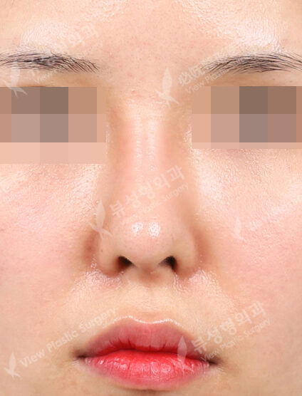 Rhinoplasty (4 Months) — After