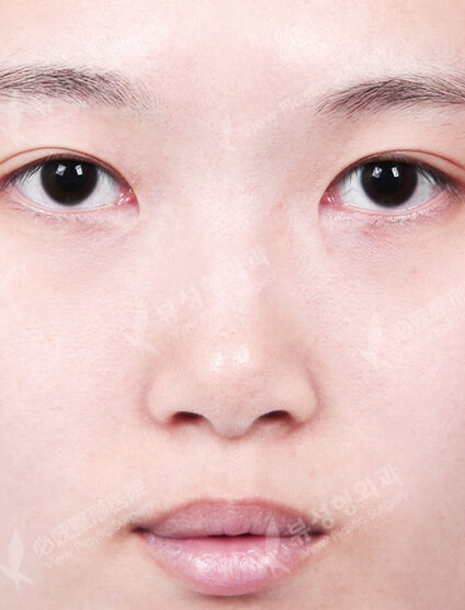 Rhinoplasty (12 Months) — Before