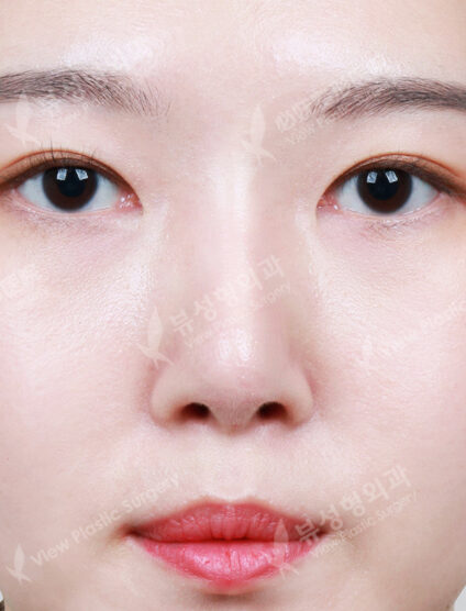 Rhinoplasty (12 Months) — After