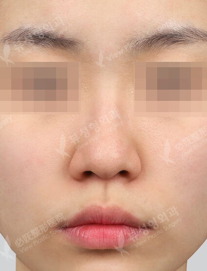 Open Septal Cartilage Graft (3 Months) — Before