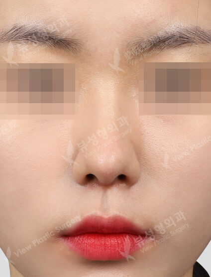 Open Septal Cartilage Graft (3 Months) — After