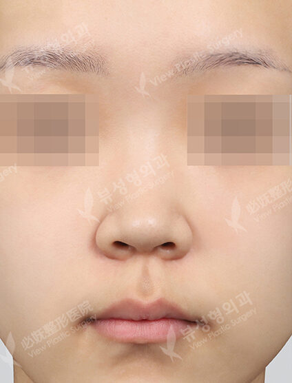 Rhinoplasty+Lengthening +GoreTex Foreign Body (3 Months) — Before