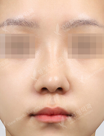 Rhinoplasty+Lengthening +GoreTex Foreign Body (3 Months) — After